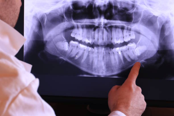 Best Emergency Wisdom Tooth Extraction in Hill N Dale, FL